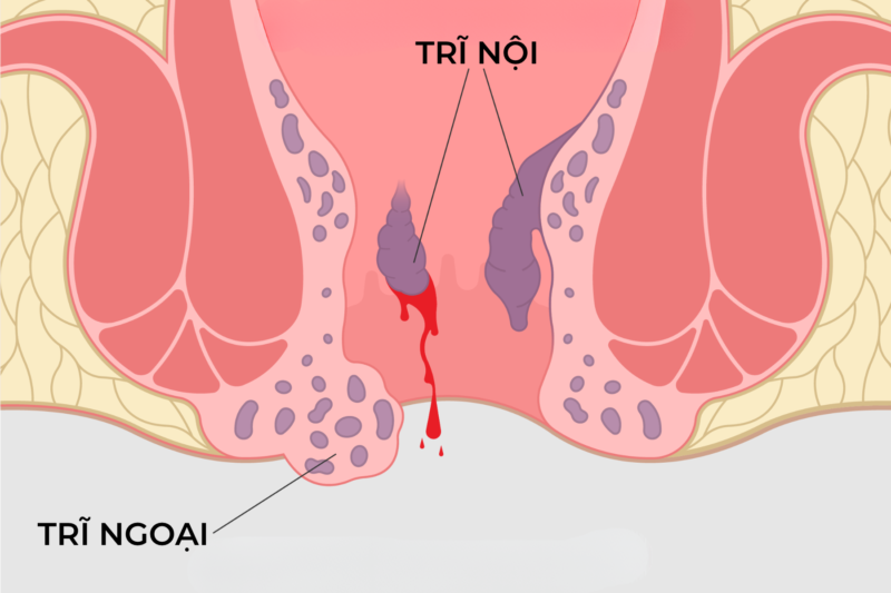 Điều trị trĩ nội tại nhà có hiệu quả không? Phương pháp an toàn, hạn chế tái phát