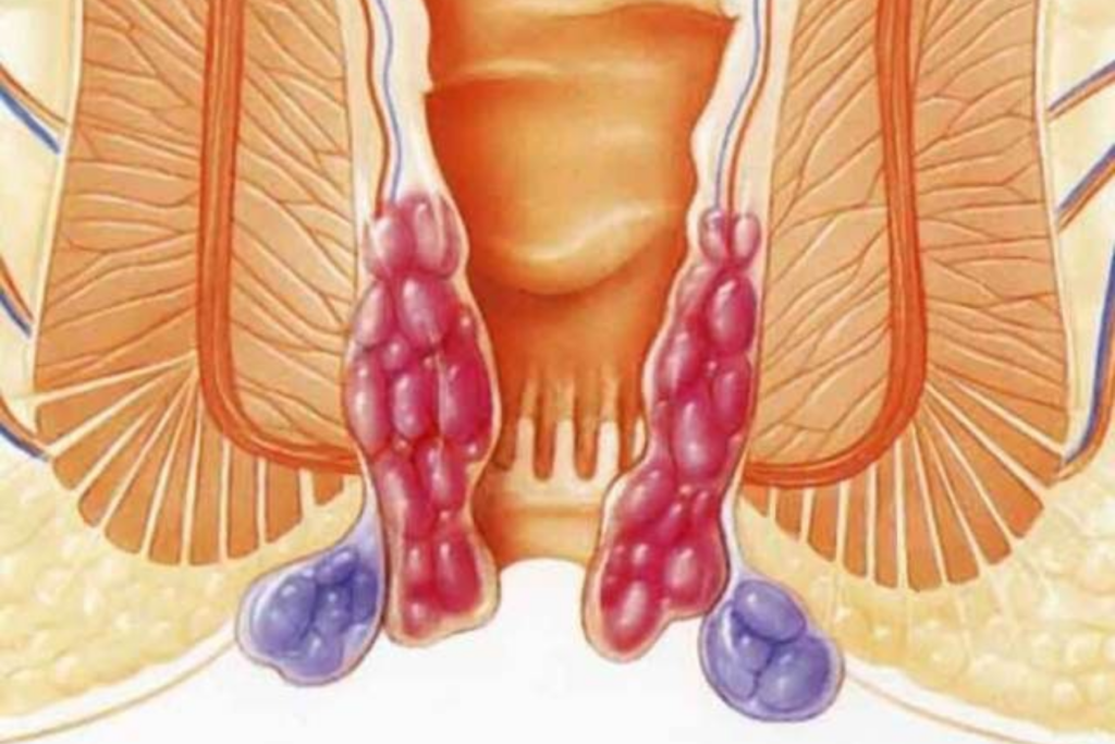 Nguyên nhân gây bệnh trĩ là gì? Dấu hiệu nhận biết và cách điều trị hiệu quả 