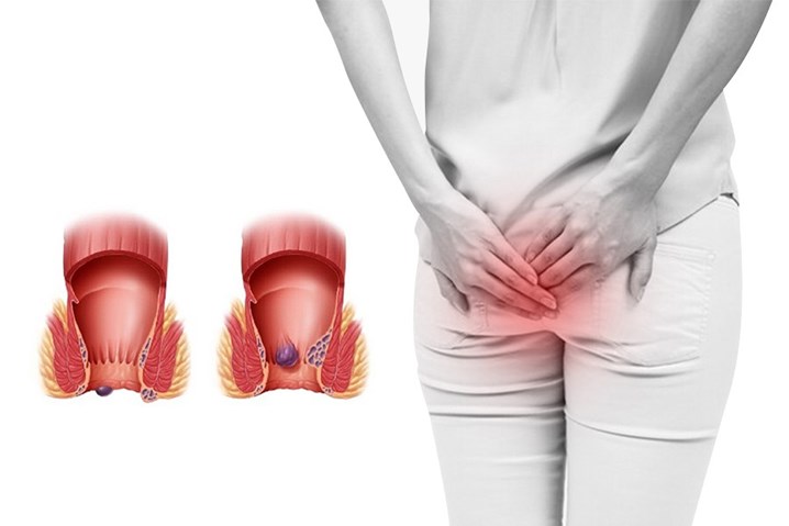 8 hiểu lầm phổ biến khiến bệnh trĩ điều trị mãi không khỏi 